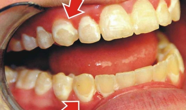 Tình trạng thiểu sản men răng