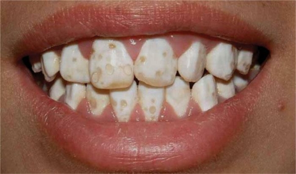 Các triệu chứng điển hình của bệnh thiểu sản men răng