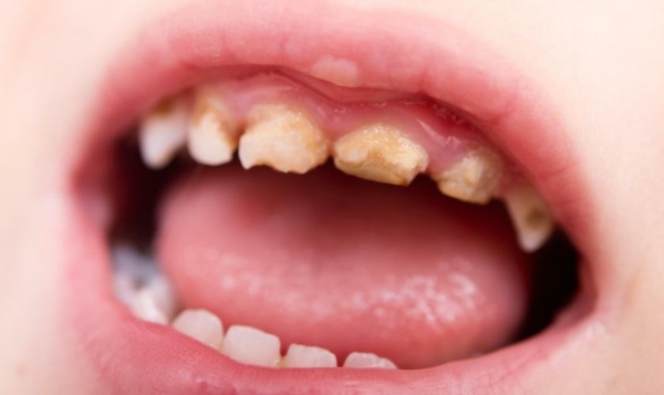 Thiểu sản men răng khiến răng dễ bị sâu và mòn nhanh hơn bình thường