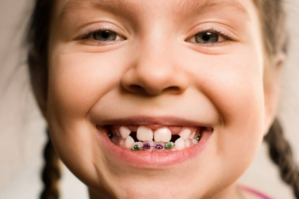 Các trường hợp cần niềng răng ở trẻ