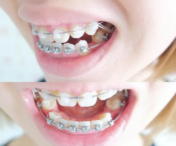 Niềng răng giúp người trưởng thành khắc phục các khuyết điểm về răng, nâng cao thẩm mỹ và chức năng ăn nhai
