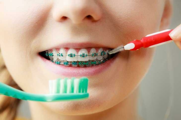 Vệ sinh răng miệng sạch sẽ hàng ngày là điều cực kỳ quan trọng giúp giữ gìn kết quả niềng răng lâu dài