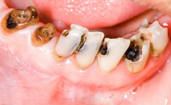 Sâu răng là tình trạng răng bị tổn thương do sự tấn công của vi khuẩn gây hại