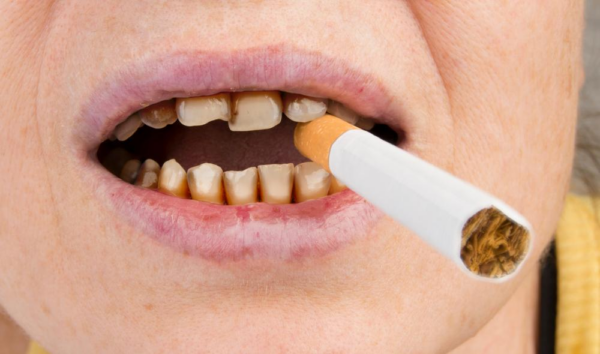 Hút thuốc lá làm tăng các bệnh về nướu và răng