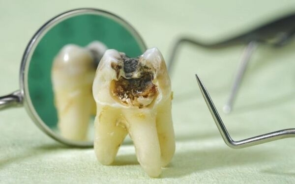 Sâu răng có nhiều nguyên nhân, trong đó vi khuẩn là yếu tố chính gây bệnh