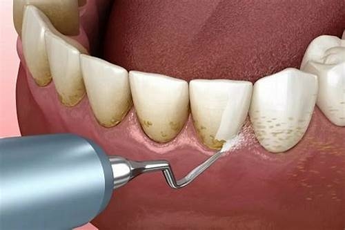 Lấy cao răng giúp làm sạch các vết bẩn, vôi răng và vết ố vàng bám trên bề mặt răng