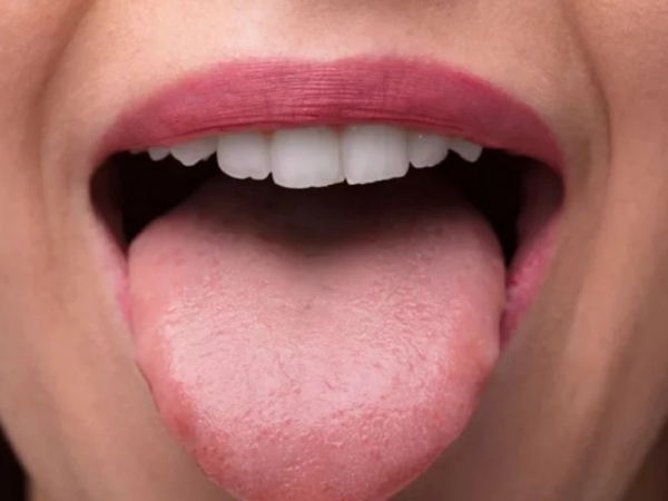 Thế nào được coi là lưỡi khỏe mạnh?