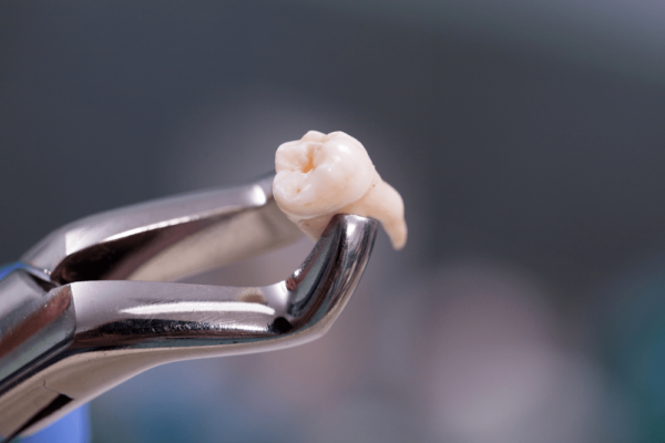 Nhổ răng khôn có được bảo hiểm y tế không?
