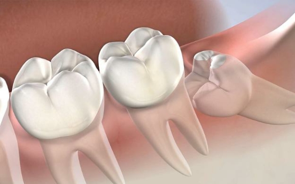 Những trường hợp nhổ răng khôn được bảo hiểm y tế chi trả