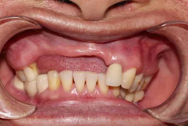 Xương hàm bị lộ rõ, tụt lợi nghiêm trọng khi để mất răng quá lâu
