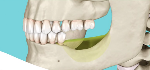 Khi để mất răng quá lâu mới cấy ghép implant, nguy cơ thất bại sẽ rất cao do xương hàm đã bị teo dần theo thời gian