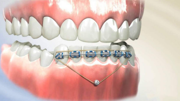 Quy trình cụ thể của việc tháo niềng răng