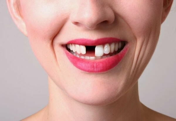 Gãy răng gây ra nhiều tác hại nghiêm trọng đến sức khỏe