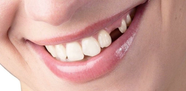 Khi bị gãy, răng sẽ không có khả năng tự mọc lại được