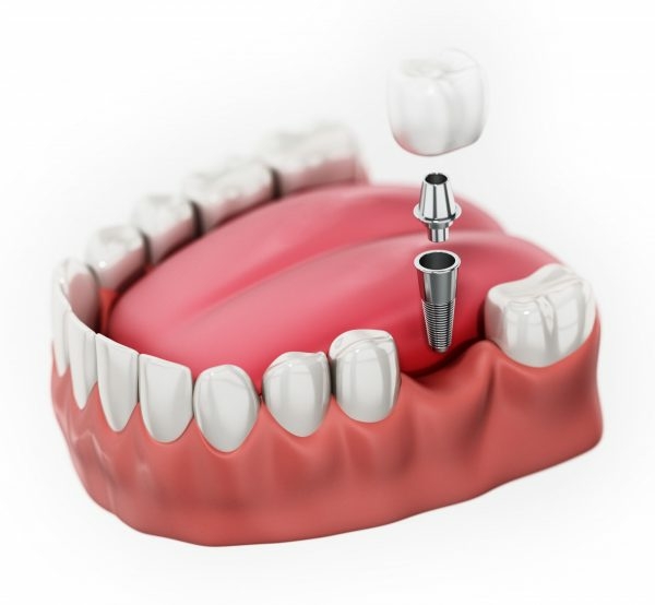 Nhổ răng và trồng implant là giải pháp cuối cùng đối với trường hợp răng bị gãy hoàn toàn