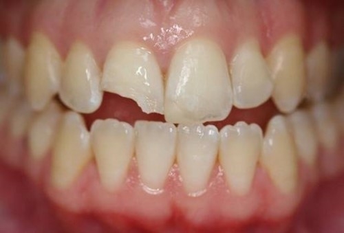 Cách điều trị gãy răng sẽ tùy thuộc vào mức độ tổn thương của từng trường hợp