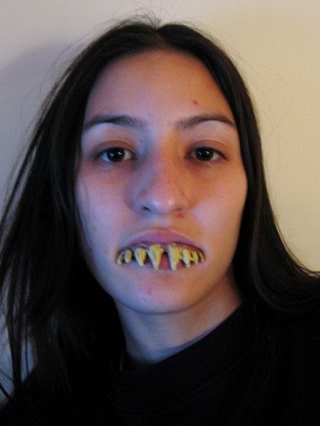 Cô gái Nhật Bản có răng hàm dị hình giống răng ma cà rồng