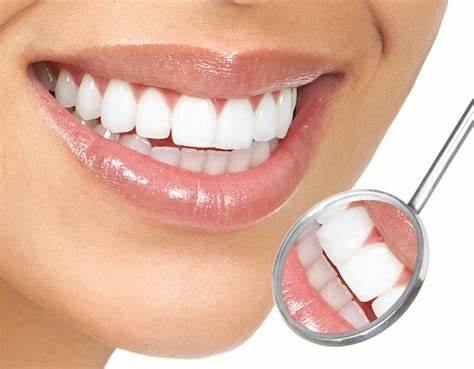 Bọc răng sứ veneer là phương pháp làm đẹp răng vô cùng phổ biến hiện nay