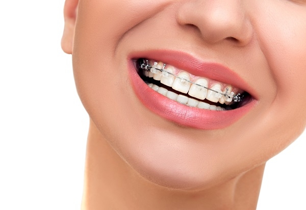 Niềng răng thẩm mỹ là lựa chọn lý tưởng để khắc phục triệt để các khuyết điểm về răng