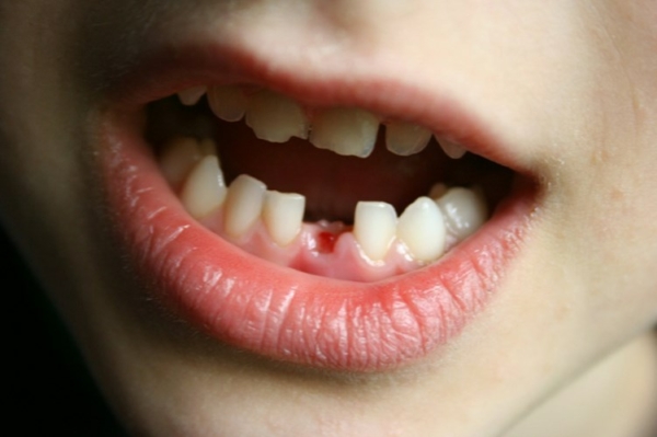 Nếu trẻ 14 tuổi chỉ nhổ bỏ răng sữa mà chưa mọc răng vĩnh viễn thay thế, thì răng vẫn có khả năng mọc trở lại bình thường