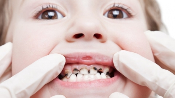 Tình trạng sâu răng ở trẻ rất dễ gặp phải