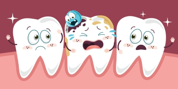 Răng có những vết sứt mẻ, lỗ nhỏ màu vàng, nâu hoặc đen là dấu hiệu điển hình nhất của sâu răng
