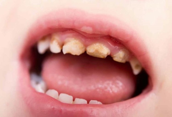Nguyên nhân sâu răng hàm ở bé 4 tuổi là gì?