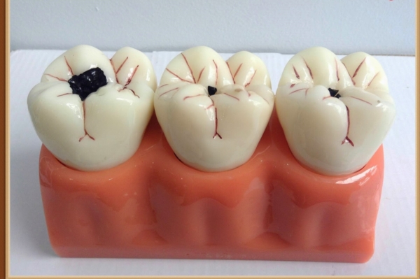 Sâu răng là tình trạng viêm nhiễm và hủy hoại các cấu trúc bên trong răng