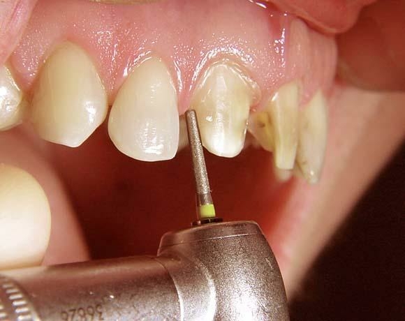 Làm răng sứ không đúng kỹ thuật là một trong những nguyên nhân phổ biến nhất gây ra tình trạng hôi miệng