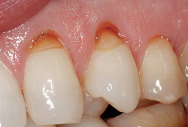 Trám răng bị mòn cổ giúp phục hồi vẻ ngoại hình tự nhiên