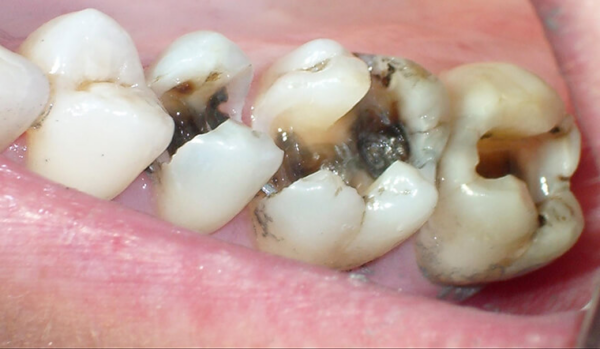 Bị sâu răng không chỉ gây ra đau đớn mà còn đe dọa sức khỏe nướu và răng của bạn.