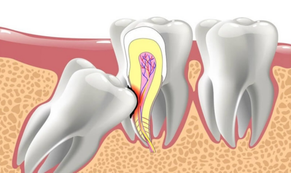 Răng khôn mọc lệch gây ra sự không thoải mái khi nhai và đau đớn