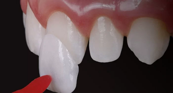 Dán sứ Veneer là một phương pháp thẩm mỹ hiện đại giúp cải thiện hình dáng và màu sắc của răng