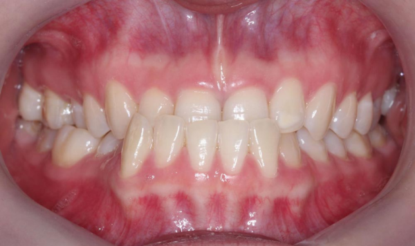 Tình trạng răng móm làm thay đổi hình dạng tổng thể của khuôn mặt