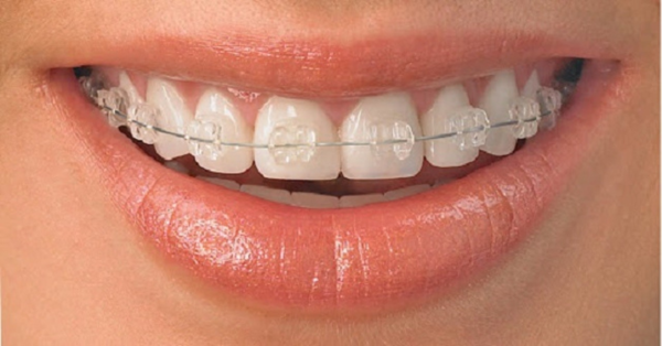 Niềng răng mắc cài sứ là một trong những giải pháp tiên tiến và thẩm mỹ