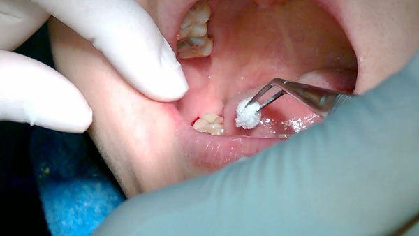 Nhổ răng khôn là một phương pháp chính để điều trị viêm lợi trùm