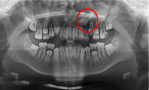 Dấu hiệu nhận biết răng mọc trên lợi