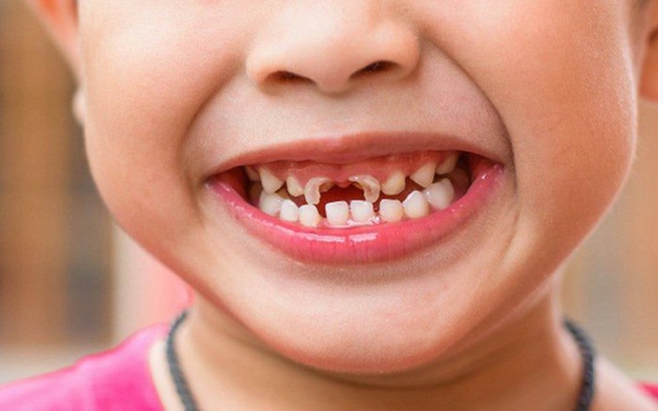 Hình ảnh răng sữa của trẻ bị mòn