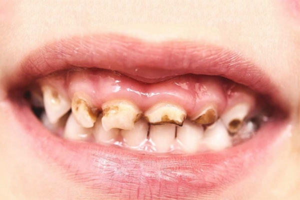 Có nhiều nguyên nhân dẫn đến răng sữa bị mòn ở trẻ