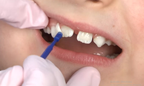Điều trị bằng florua là một phương pháp đơn giản để củng cố và phục hồi lớp men răng bị mòn
