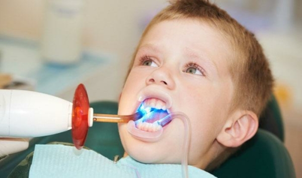 Trám răng là giải pháp điều trị mòn răng sữa lâu dài và hiệu quả nhất