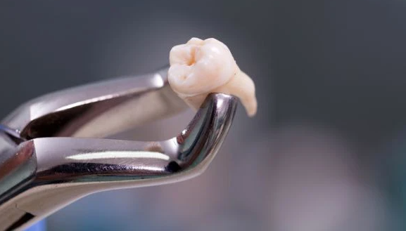 Việc giữ lại răng sau khi nhổ có lợi ích gì không?