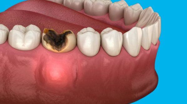 Những răng bị hư hỏng không nên giữ lại sau khi nhổ