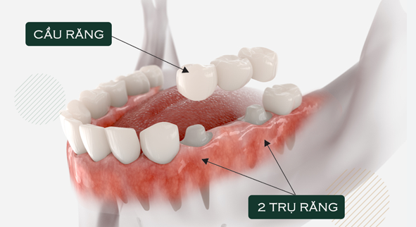Chi phí trung bình để làm một cầu răng sứ thông thường cho 1 răng sẽ là khoảng 3 – 5 triệu đồng
