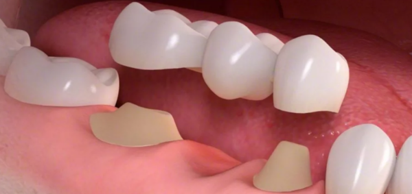 Làm cầu răng sứ sẽ không gây đau nhờ áp dụng gây tê tại chỗ