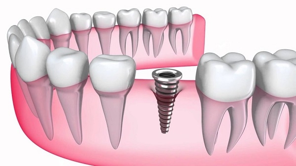 Dù mất răng lâu năm nhưng vẫn hoàn toàn có thể phục hình lại răng bằng nhiều cách khác nhau