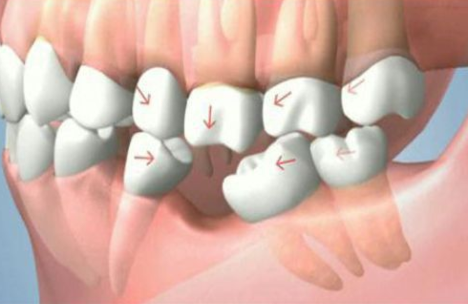 Do khoảng trống các răng bên cạnh sẽ dịch dần vào chỗ trống của răng bị mất