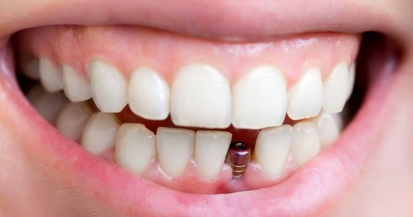 Trồng răng implant được đánh giá là phương pháp tốt nhất để thay thế răng bị mất