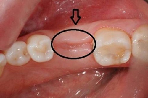 Quá trình lành vết thương sau nhổ răng thường hoàn thành sau khoảng 2 tuần