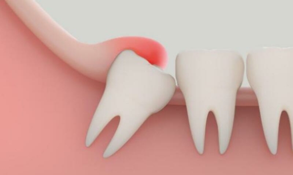 Triệu chứng sưng nướu của răng khôn là gì?